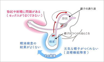 男性不妊の原因イラスト