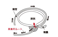 逆行性射精