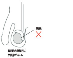 非閉塞性無精子症イラスト